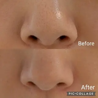 毛穴フェイシャルエステkokotto板橋所属・板橋美肌ハーブ ピーリング1位のエステ・リラクイメージ