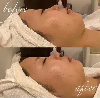 毛穴/ピーリング ララピール/POLAのエステ・リラクイメージ