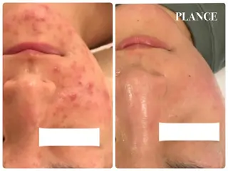 フェイシャル専門 肌質改善/プランスのエステ・リラクイメージ