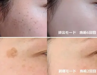 顔脱毛&毛穴&ニキビ 優良№1♪ヒロコ♪のエステ・リラクイメージ