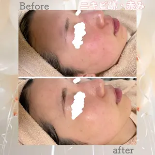 セミロング カラー パーマ ヘアアレンジ メンズ キッズ ネイル マツエク・マツパ アイブロウ ニキビ&跡改善サロン オーナー光木のエステ・リラクイメージ