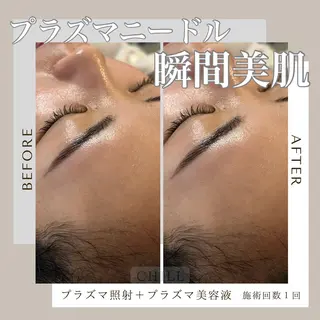 カッピング/プラズマ CHILLのエステ・リラクイメージ