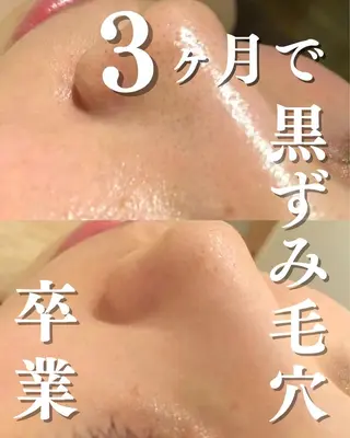 ニキビ特化型エステ 🍋最短で肌質改善のエステ・リラクイメージ