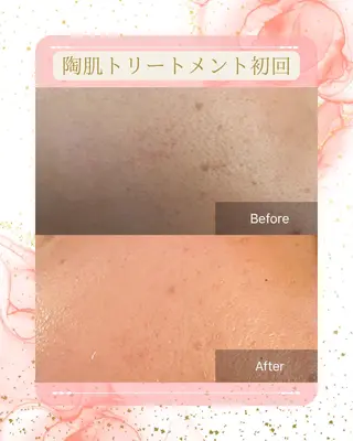 美楽鍼 美容鍼のエステ・リラクイメージ