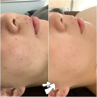 ニキビケアサロン|Motorihi【モトリヒ】所属・ニキビケア Moto rihi【モトリヒ】のエステ・リラクイメージ