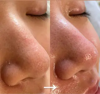 毛穴レス ハーブ& ワックス脱毛×光脱毛のエステ・リラクイメージ