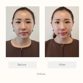 即効⚡小顔美容鍼🪡 むくみたるみ脂肪解消のエステ・リラクイメージ