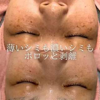 ハーブピーリング・ シミ・毛穴専門サロンのエステ・リラクイメージ