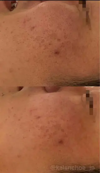 肌質改善 KALANCHOEのエステ・リラクイメージ