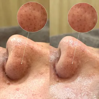 Suu.千種/今池 毛穴洗浄/韓国肌管理のエステ・リラクイメージ