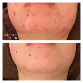 セミロング パーマ ヘアアレンジ メンズ キッズ ネイル マツエク・マツパ アイブロウ ニキビ跡専門サロン Ainaのエステ・リラクイメージ