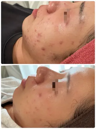 【リベルハーブピーリング認定店】敏感肌・美白脱毛専門店Dione立川店所属・Dione 立川店のエステ・リラクイメージ