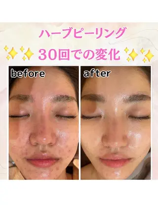 【韓国肌管理】ハーブピーリング　A.DIOR   GINZA所属・松尾 実歩のエステ・リラクイメージ
