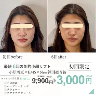 最速小顔・肌質管理 ❣️エスポワールのエステ・リラクイメージ