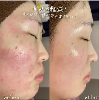 【ハーブピーリング/毛穴洗浄】NA skin 川崎店〜ニキビ・毛穴専門店〜所属・NAホワイトニング 川崎店のエステ・リラクイメージ