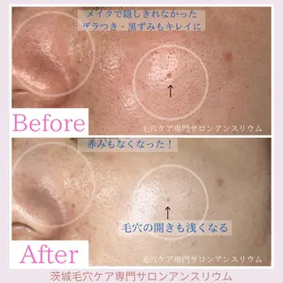 毛穴ケア専門サロンアンスリウム所属・茨城土浦 つくば毛穴 ケア専門サロンのエステ・リラクイメージ