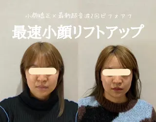 最速小顔・肌質管理 ❣️エスポワールのエステ・リラクイメージ