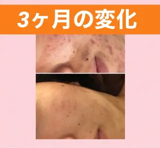 メンズ キッズ ニキビ 専門のエステ・リラクイメージ