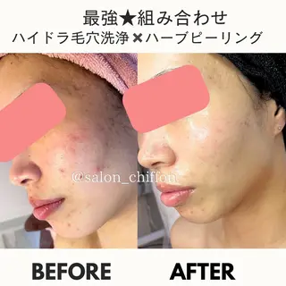 肌質改善エステ chiffonのエステ・リラクイメージ