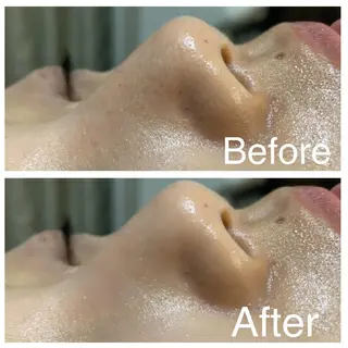 メンズ 医療提携Ruby所属・医療提携Ruby小顔 ハーブピーリングのその他イメージ