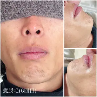 宮代・脱毛サロンMIIN所属・脱毛/ホワイトニング 美白ケア🫧MIINのエステ・リラクイメージ