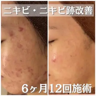 撲滅🔥 最短ニキビ改善のエステ・リラクイメージ