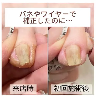 ネイル 深爪・巻き爪 専門サンセリテのネイルデザイン