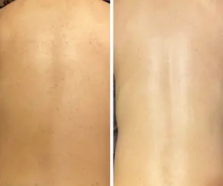 ハーブピーリング re:proのエステ・リラクイメージ