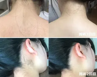 顔脱毛&毛穴&ニキビ 優良№1♪ヒロコ♪のエステ・リラクイメージ