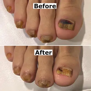 ネイル Mellow nail所属・巻爪無料モデル募集 ✨🦶MEGUMIのネイルデザイン