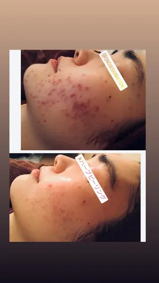 ニキビ/肌質改善専門 Snow skinのエステ・リラクイメージ