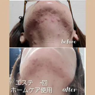 デ・アイム王寺所属・たるみ解消エミリーノ 米田真美子のエステ・リラクイメージ