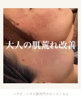 セミロング パーマ ヘアアレンジ メンズ キッズ ネイル マツエク・マツパ アイブロウ ニキビ跡専門サロン Ainaのエステ・リラクイメージ