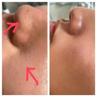 毛穴フェイシャル エステ専門店BBのエステ・リラクイメージ