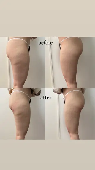 Miiju.所属・Miiju. 石巻市 脂肪冷却  鈴木のエステ・リラクイメージ