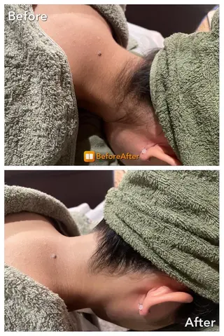 Meupニキビ専門店 背中/ハーブ/ララのその他イメージ