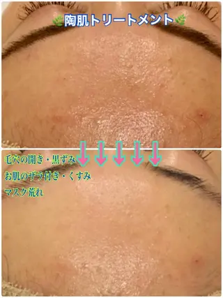 【リベルハーブピーリング認定店】敏感肌・美白脱毛専門店Dione立川店所属・Dione 立川店のエステ・リラクイメージ