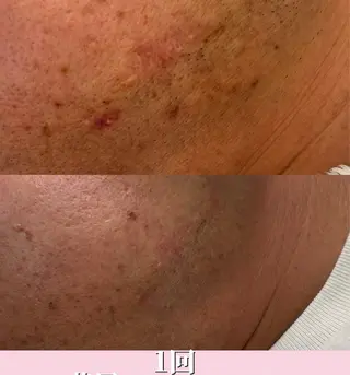 メンズ Blooming所属・LOUISE. ／肌質・頭皮のエステ・リラクイメージ