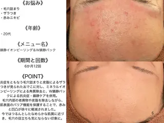 ニキビ特化型エステ 🍋最短で肌質改善のエステ・リラクイメージ