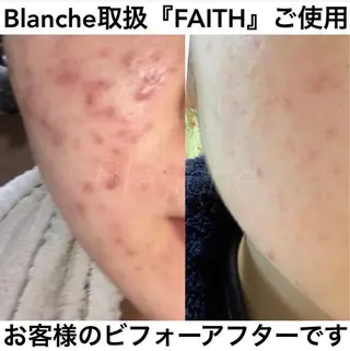 ミディアム カラー パーマ ヘアアレンジ キッズ ネイル マツエク・マツパ 都度払い肌質改善 &脱毛Blancheのエステ・リラクイメージ