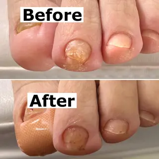 ネイル Mellow nail所属・巻爪無料モデル募集 ✨🦶MEGUMIのネイルデザイン