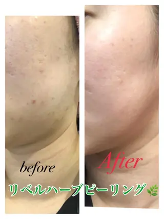 【リベルハーブピーリング認定店】敏感肌・美白脱毛専門店Dione立川店所属・Dione 立川店のエステ・リラクイメージ