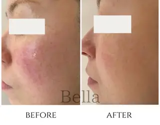 肌質改善ハーブ ピーリングBellaのエステ・リラクイメージ