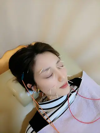 リフトアップ・たるみ ☆美容鍼小顔矯正のその他イメージ