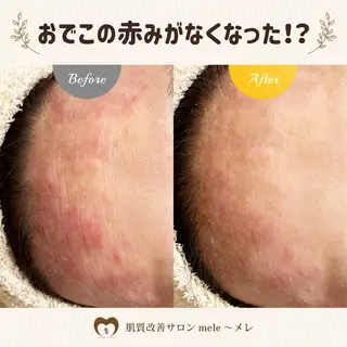 ニキビケア/毛穴/ 赤み/自信の肌✨森園のエステ・リラクイメージ