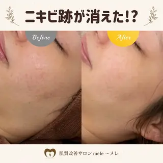 ニキビケア/毛穴/ 赤み/自信の肌✨森園のエステ・リラクイメージ