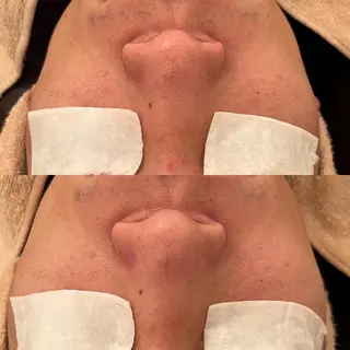 メンズ 毛穴ケア/毛穴診断/ 毛穴洗浄〔心斎橋〕のエステ・リラクイメージ