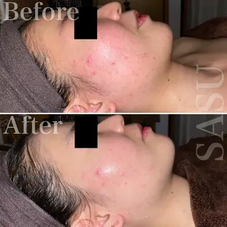 メンズ 即小顔♥️美容鍼× ハーブピーリングのその他イメージ