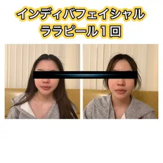 【ハイパーナイフ痩身&小顔コルギ&ハーブピーリング】K-Beauty　東新宿所属・kーbeauty痩身 フェイシャルのエステ・リラクイメージ