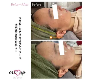 Meupニキビ専門店 背中/ハーブ/ララのその他イメージ